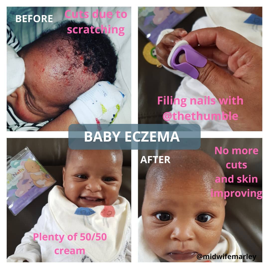 Baby eczema before-and-after collage showing nail filing with the purple Thumble by Thumble Baby Care.